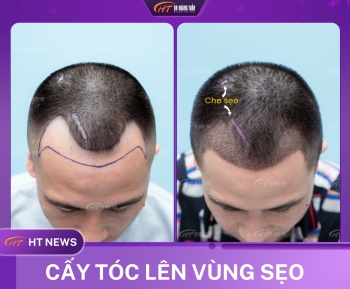 Cấy tóc trên sẹo có mọc được không? Giải đáp từ chuyên gia